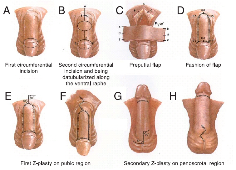 Penis Enlargement For Teenagers 4