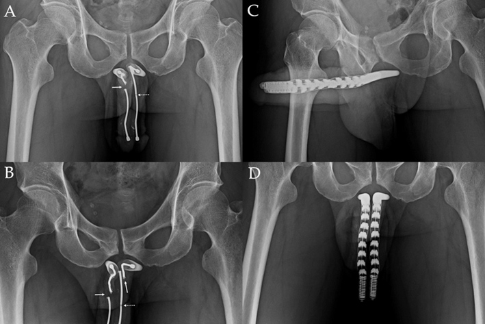 Figure 1. X-ray films of a 45-year-old male with malleable penile prosthesi...