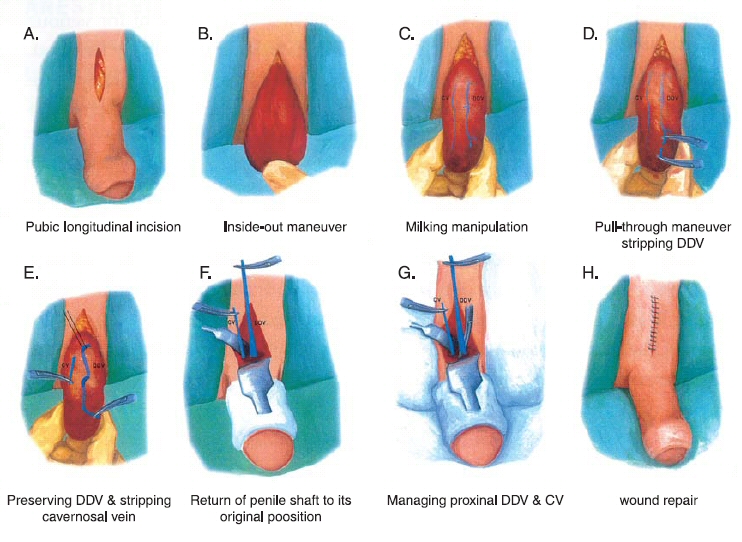 Venous Stripping Surgery Services Hsu s Andrology