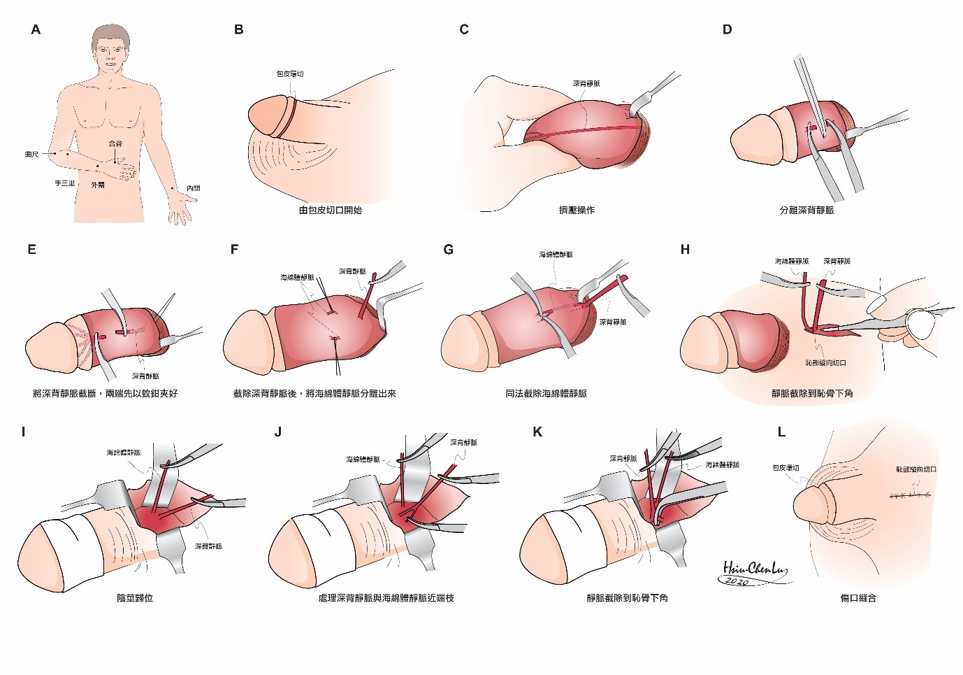 Venous Stripping Surgery Services Hsu s Andrology