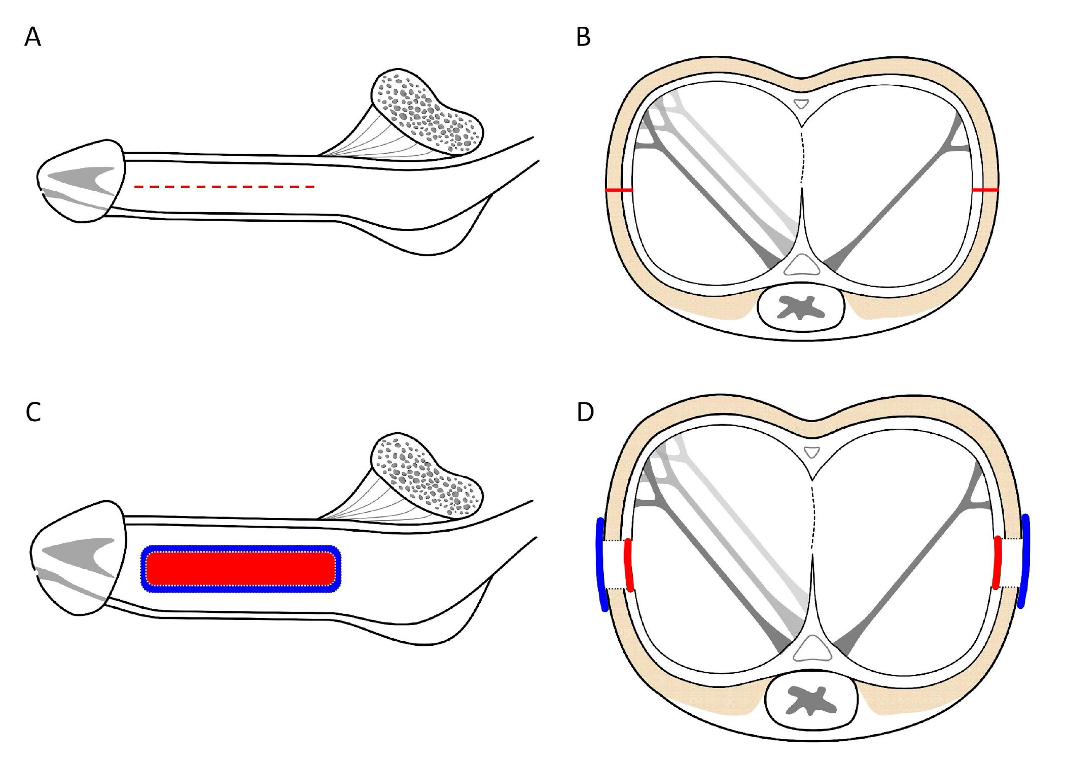 陰莖延長加大術手術示意圖 A, B, C, D