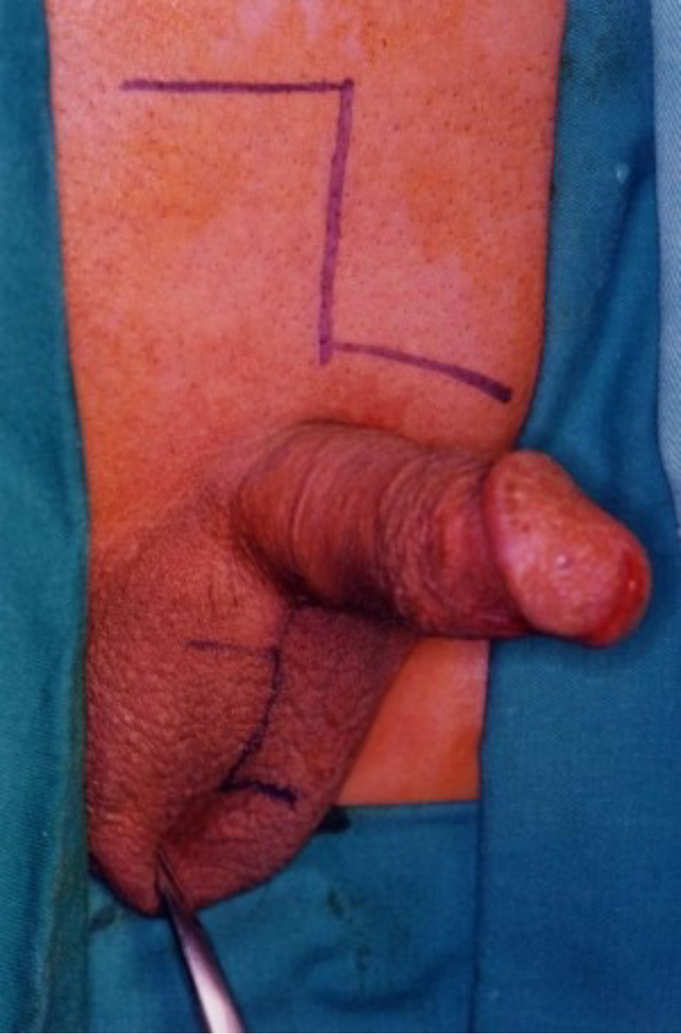 二個九十度 Ζ 型整型術設計圖