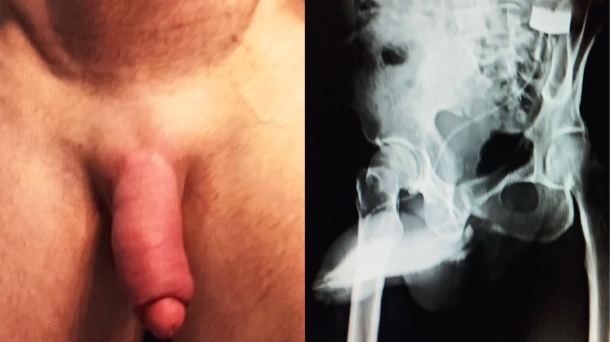 植入除細胞皮瓣後的影像 (駱駝峰)