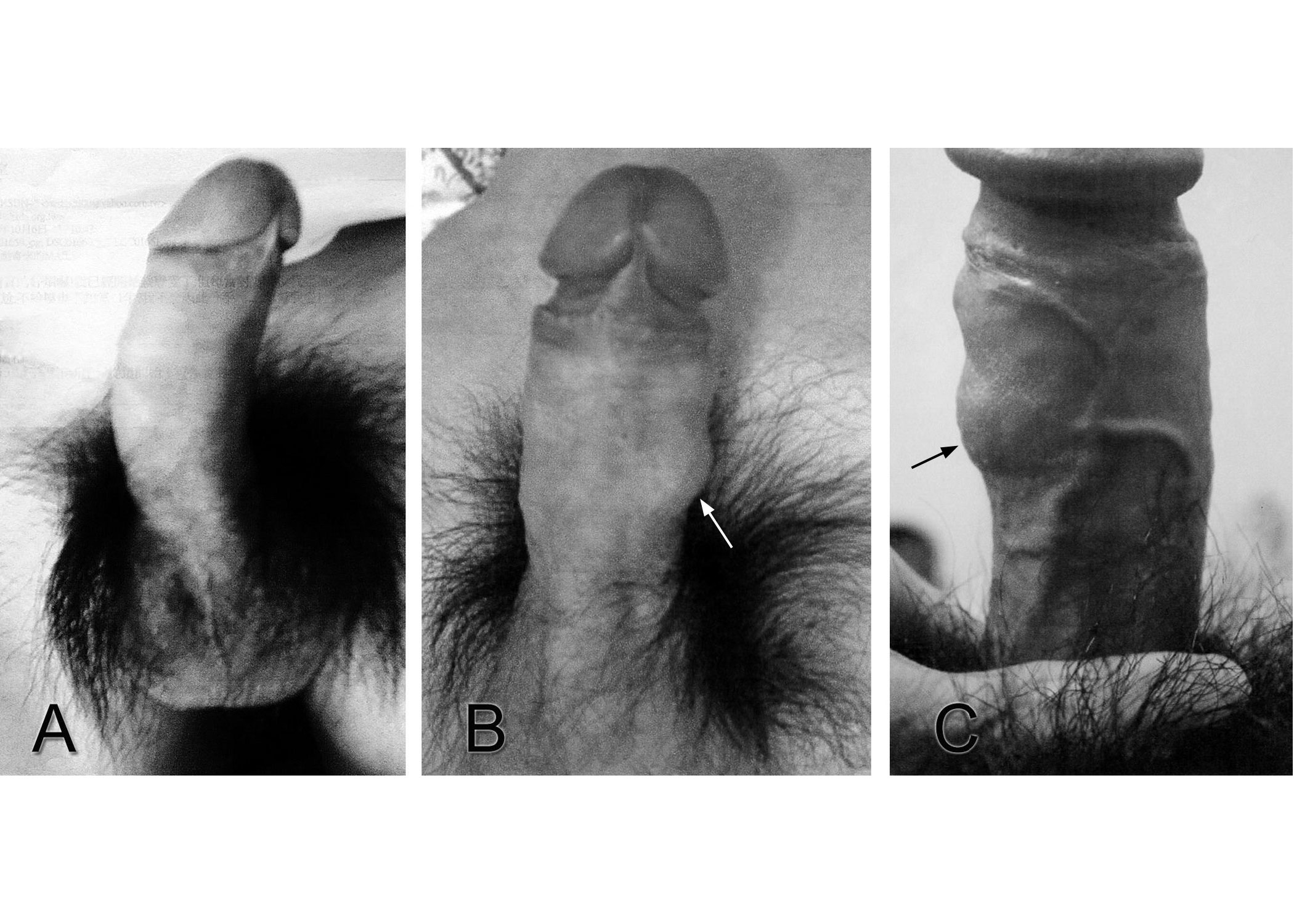 靜脈血管壁為陰莖白膜之內環層手術前後照